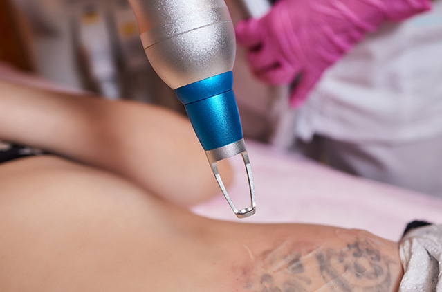 tattoo removal